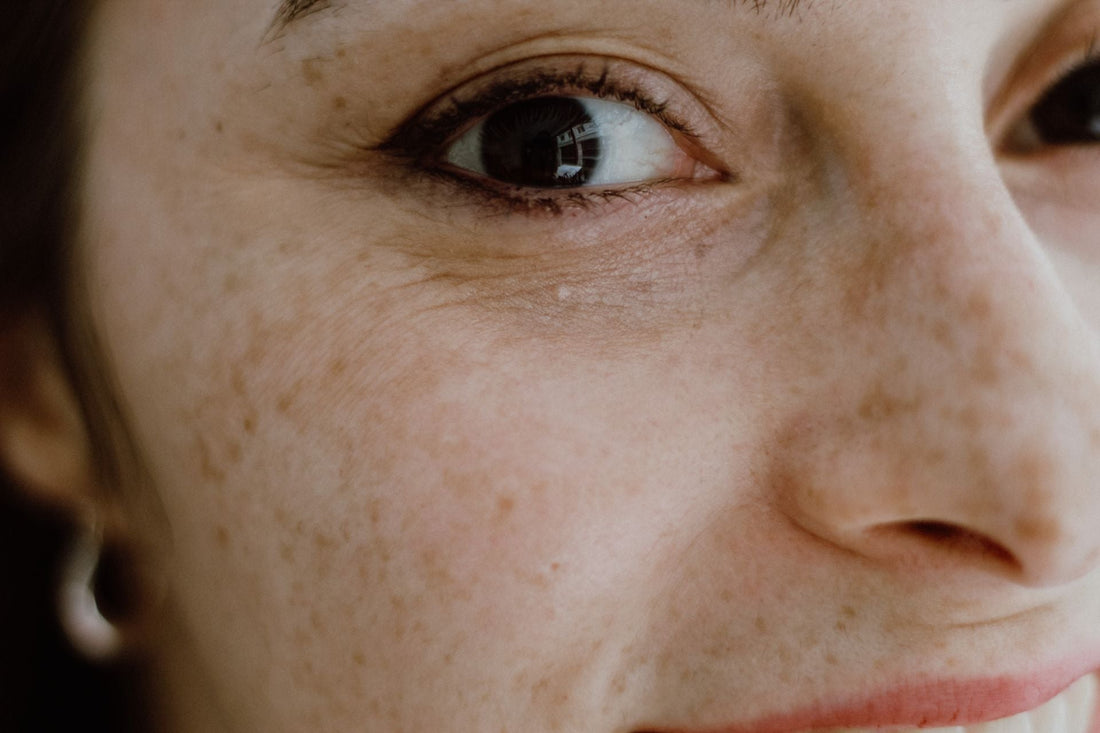 Dark Patches Ruining Your Confidence? Everything You Need to Know About Melasma & How to Finally Fix It